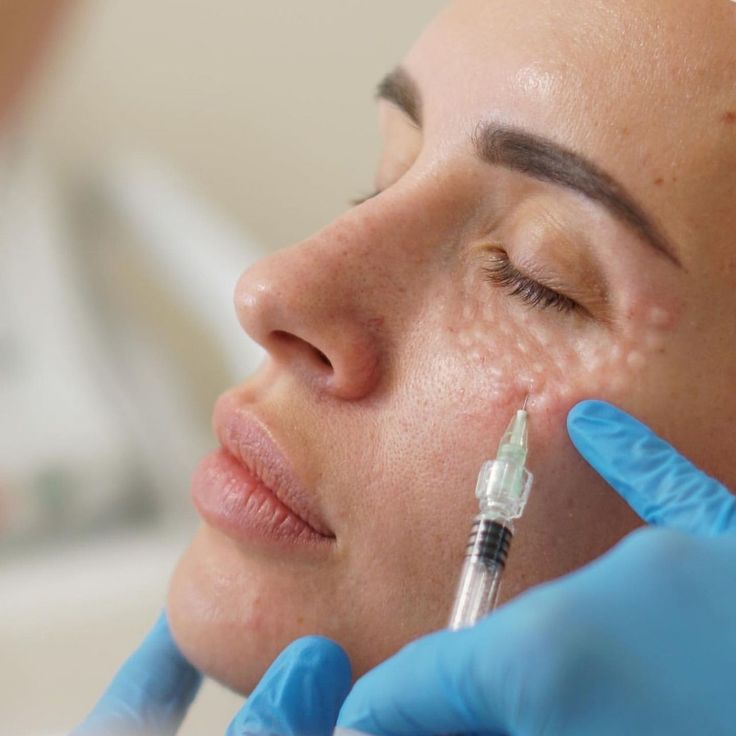 UnderEye PDRN Treatment 